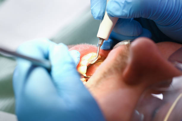 Best Dental Abscess Treatment in Lackawanna, NY